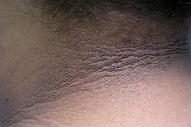 25-facts-a<em></em>bout-insulin-resistant-acanthosis-nigricans-type-a