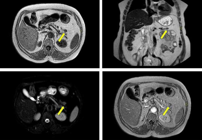 30-facts-a<em></em>bout-me<em></em>tastatic-insulinoma